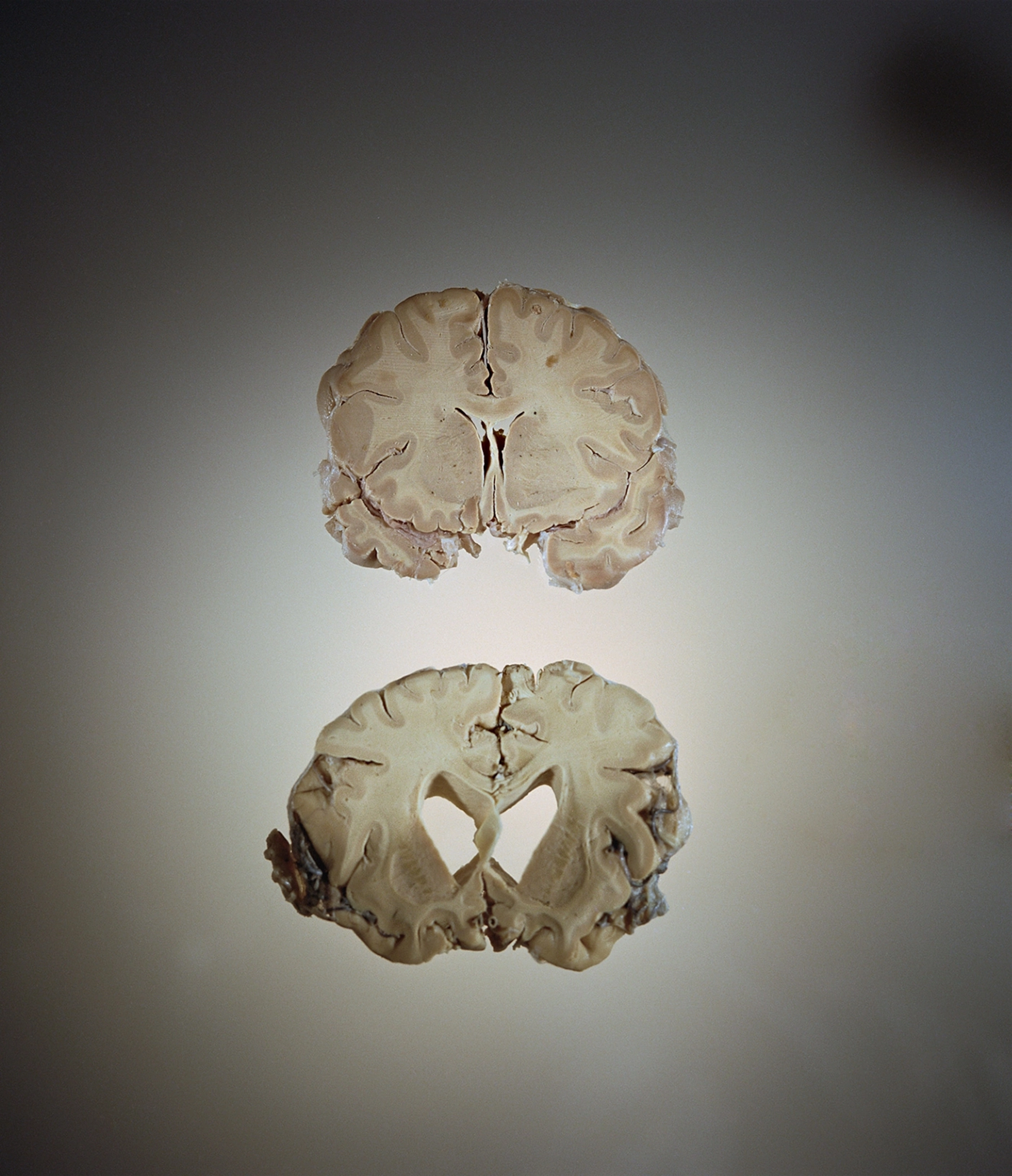 Two intersections of the brain are seen, one on the top of the photograph, and one on the bottom. The brain on the top is more full and pink where the one on the bottom is more white and has holes in the middle.