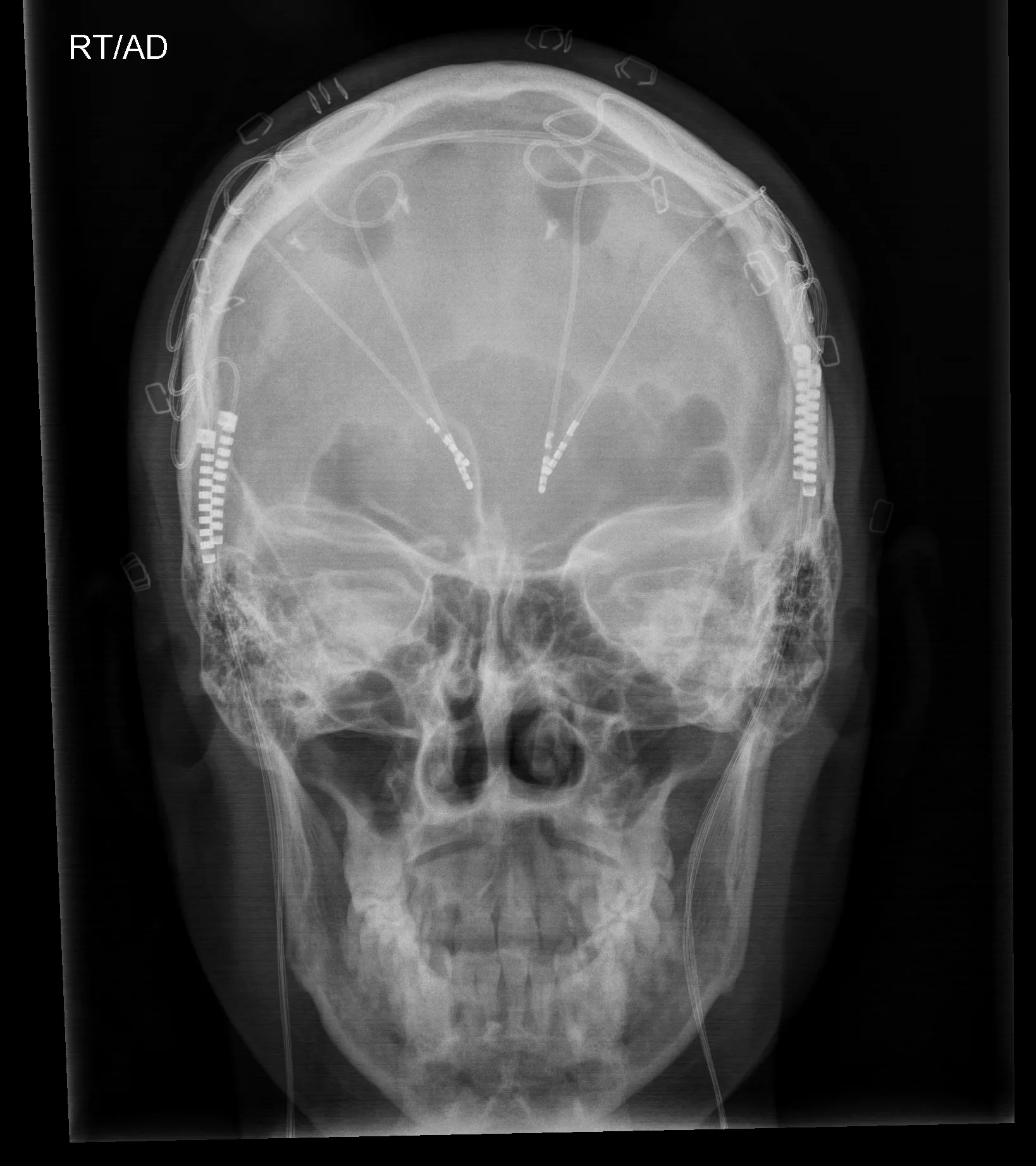 An X-ray image of a skull shows several lines slanting inward.