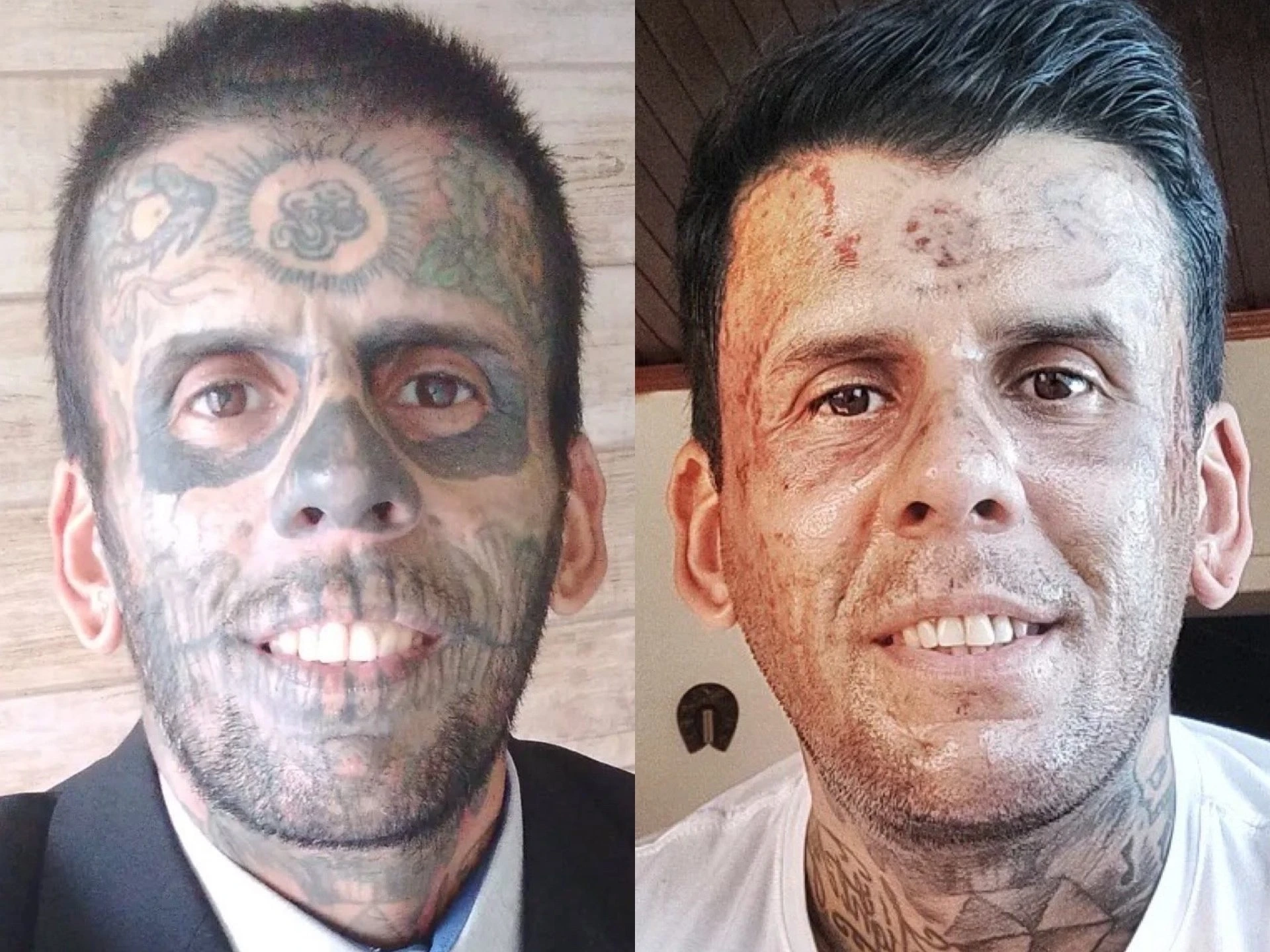Leandro de Souza, who once was tattooed on 95 per cent of his body, chronicles the painstaking removal process on social media.