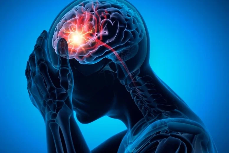 Unexpected Neuroprotective Effects of GLP-1 Agonists in Stroke Revealed at SNIS